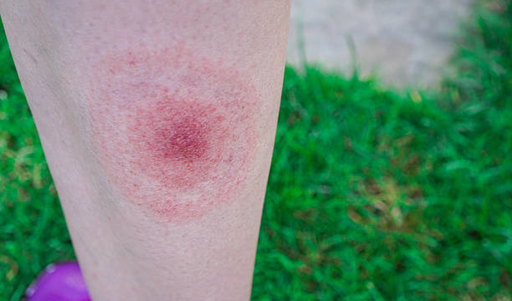 lyme disease